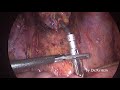 Intracorporeal side-to-end ileorectal anastomosis