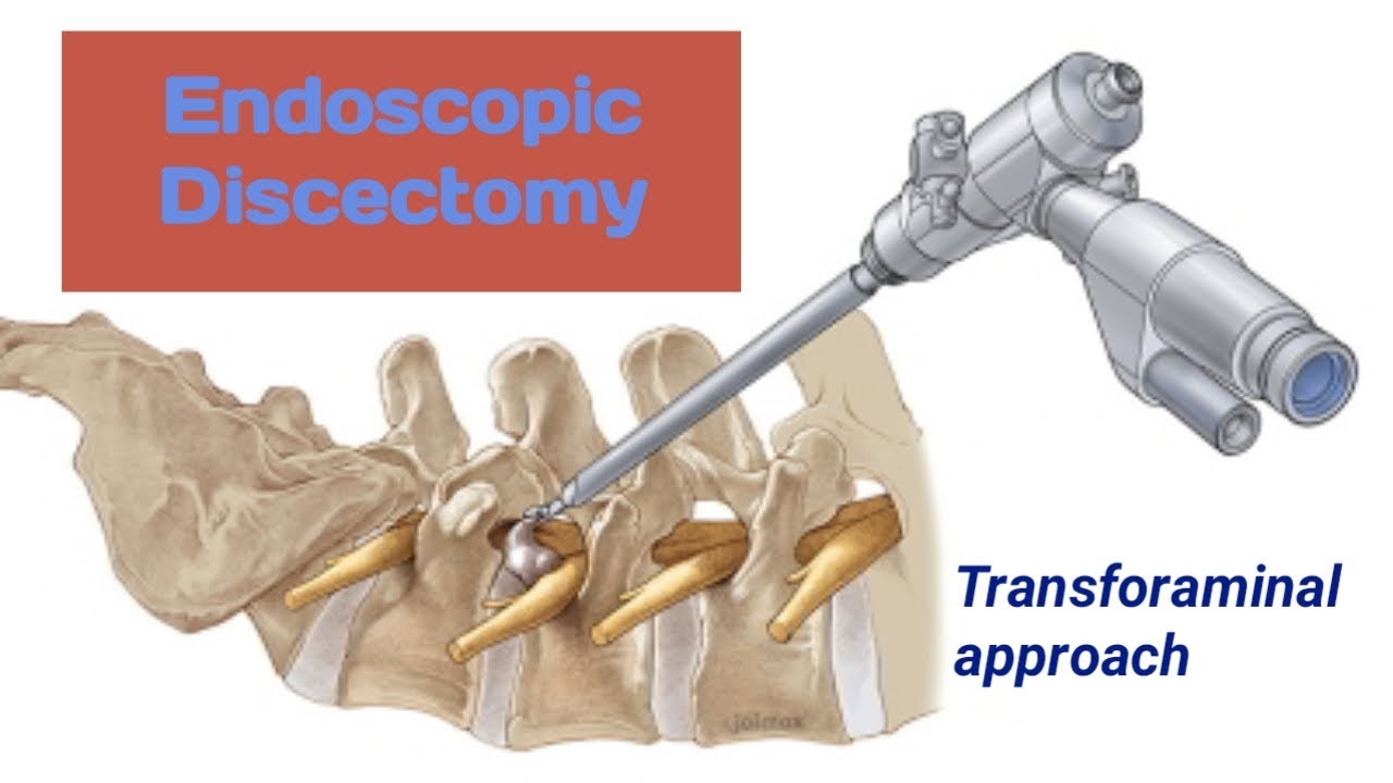 Transforaminal Endoscopic Discectomy