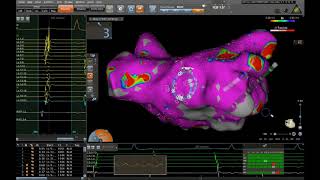 Electroanatomical mapping of the left atrium