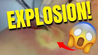 Pimple Popping Vídeos 2023 - The Best Compilation of Pimple Pop Abscess #pimple