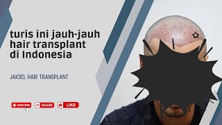 Wow Turis Dari Amerika Transplantasi Rambut Di Sini!