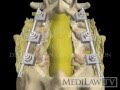 Lumbar Spine Pedicle Screw Fixation Fusion lawyer 3D animations