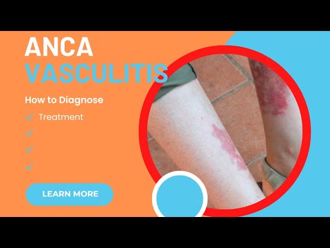 ANCA Associate Vasculitis | Cutaneous Vasculitis, Approach - YouTube