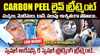 మొటిమలు శాశ్వతంగా పోయే టెక్నిక్ | Carbon Peel Laser Treatment | Glowing Skin | Pimples Removal