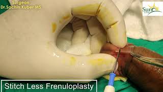 Frenulum Repair Procedure without stitches | Painful Sex,Early Discharge(PME)Treatment by Dr.Kuber