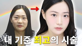 [첼 Vlog]누가 젊을 땐 이거 하지 말라 그랬어!!🤦‍♂️ 이렇게만 하면 얼굴 소멸 가능? 얼굴지방흡입+실리프팅 4개월 차 [쀼]