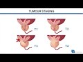 introduction to prostate cancer and primary treatment options