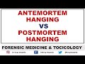 Difference between Antemortem Vs Postmortem hanging |Dr Krup Vasavda