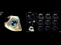 3-Dimensional Transesophageal Echocardiographic Reconstruction of Bicuspid Tricuspid Valve