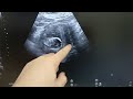 missed miscarriage oligohydramnios ultrasound scan sonography