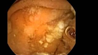 Normal Findings and Landmarks in Capsule Endoscopy