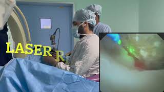 LASER STONE SURGERY -- Dr. Koushik Sharma (Urologist \u0026 Renal Transplant Surgeon)