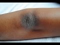 Home remedies for dark elbows and knees | How to treat dark elbows Home remedies for dark elbows and knees | How to treat dark elbows