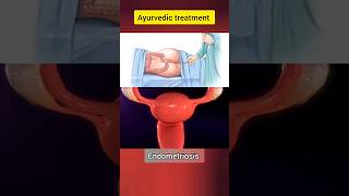 Endometriosis treatment #shorts #shortvideo #viral #endometriosis