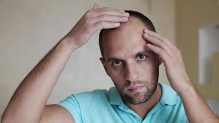 Understanding and Treating Hair Loss