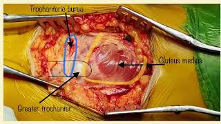 Anterolateral Approach to Hip joint