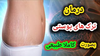 درمان ترک های پوستی به صورت کاملا طبیعی