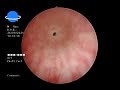 visual internal urethrotomy viu dr.aladimi