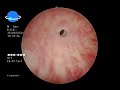 visual internal urethrotomy viu dr.aladimi