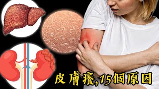 15個發癢原因,您可能未聽過的,自然療法,柏格醫生 Dr Berg