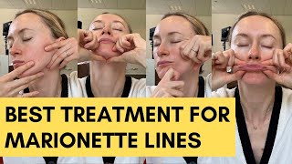 How to treat marionette lines/wrinkles