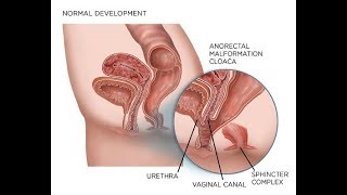 Persistent Cloaca!! How are  Persistent cloaca (Medical Condition)