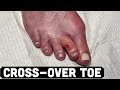 MINIMALLY INVASIVE HAMMERTOE CORRECTION (Upcoming Case)