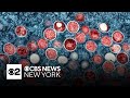 New York issues Mpox warning amid outbreak in Africa