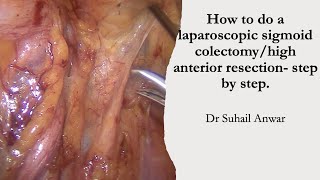 How to do a laparoscopic sigmoid colectomy/ high anterior resection ? Step by step. Dr S Anwar