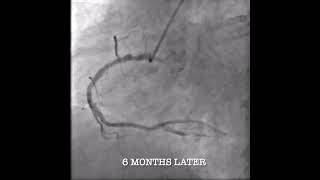 DCB in various coronary arteries.