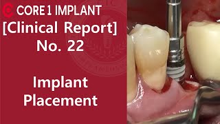 [CYBERMED Clinical Report] Implant on #15, 24, 35