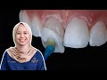 Ini Kesan Pakai Fake Veneer