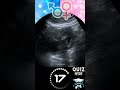 Ultrasound Quiz-26: Can You Guess?  Boy or Girl? | Quiz-26 | #ultrasound #baby #babygenderprediction