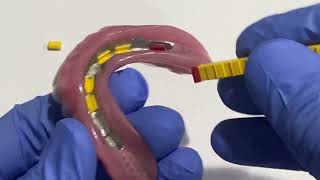 Changing Hader Clips to Increase Denture Stability