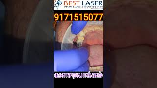 Screw retained basal dentalimpalnts for upper molar teeth replacement bestlaser clinic Chennai India