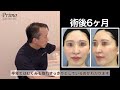 フェイスリフトのダウンタイム！切開リフト症例を詳しく解説。傷跡まで全て見せます！★☆美容整形・切開リフト☆★