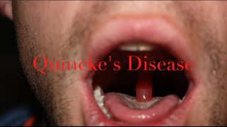 quinckes disease - medical minute