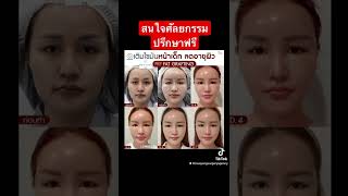 รีวิวฉีดไขมันหน้าเด็ก ย้อนวัยด้วยไขมัน Stem cell ของคุณเอง เคล็ดลับหน้าเด็กผิวฟูอิ่ม