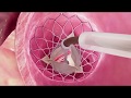 Transcatheter Aortic Valve Replacement (TAVR) for Aortic Stenosis