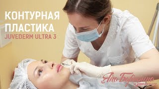 Контурная пластика. Препарат Juvederm Ultra 3