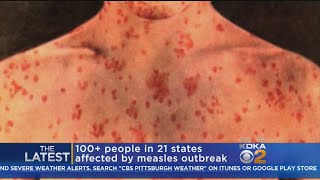 Doctors Urging Parents To Vaccinate Kids As Measles Spreads Across US