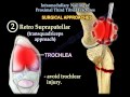 Intramedullary Nailing Proximal Tibial Fractures - Everything You Need To Know - Dr. Nabil Ebraheim