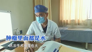 女子曾患乳腺癌，如今胰腺又发现肿瘤，医生：长到一定程度就停了