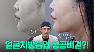 얼굴지방흡입 성공비결은? 실제 수술사례 케이스리뷰 😲✏️ | 라라성형외과