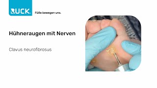 Behandlung von Hühneraugen mit Nerven: Die Top Tipps