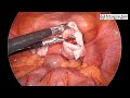 bilateral ovarian dermoid dermoid cyst