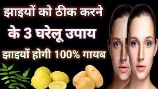 झाइयों के 3 ऐसे घरेलू इलाज जिससे आपकी झाइयां 100% गायब हो जाएगी.3 best remedies for pigmentation