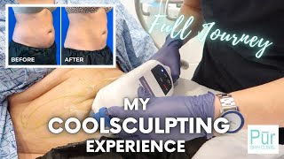 My COOLSCULPTING EXPERIENCE | Full Journey + COOLSCULPTING BEFORE AND AFTER Photos | Pūr Skin Clinic