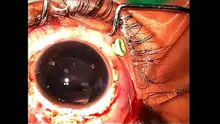 AIOC2018 - VT77 - Facing the Giants… Scleral Tuck IOL vs Others...