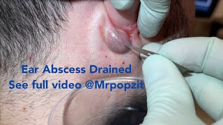 Ear abscess uploaded today on my channel. Come see the whole procedure @mrpopzit